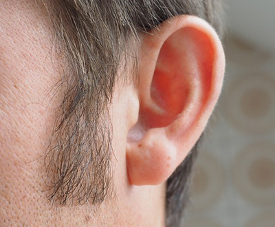 Hearing loss